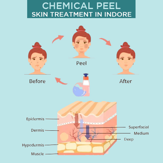 Happens During Chemical Peel Treatment in Indore: clearing skin for Free of Dirt, Grease, and Residues of Skin Cosmetics.